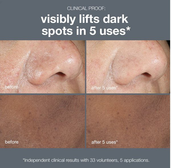 Dermalogica dark spot peel results